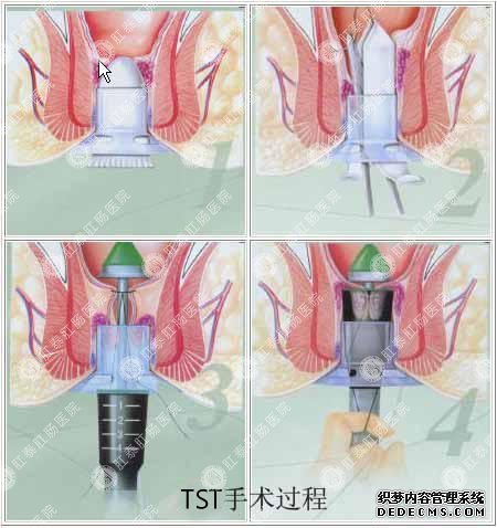 泌尿TST手术过程